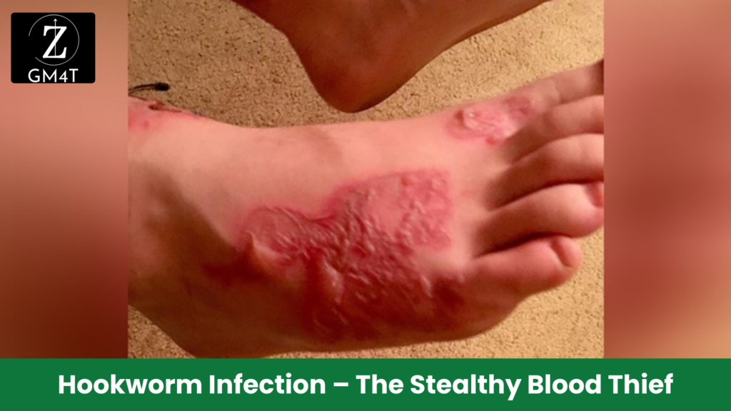 Hookworm Infection – The Stealthy Blood Thief